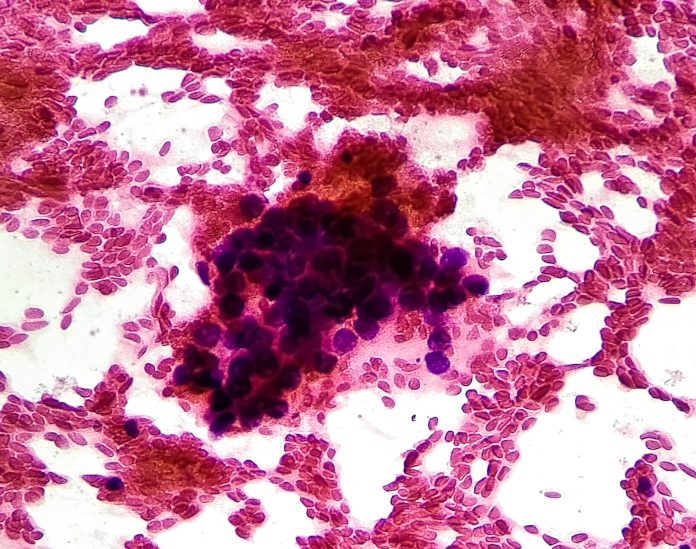 HIV e tumori: focus sull’epatocarcinoma (hepatocellular carcinoma, HCC)
